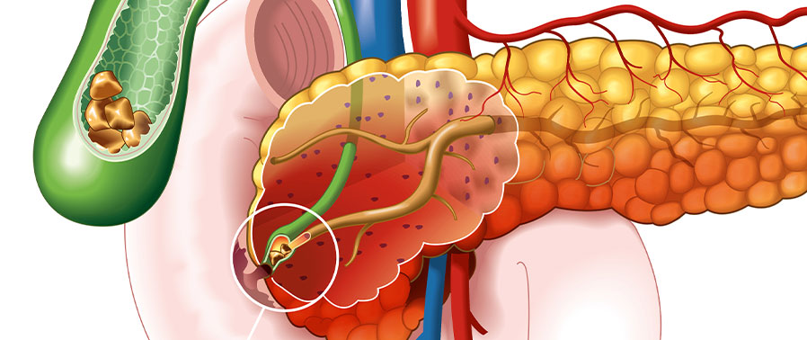 Gallstone Ileus