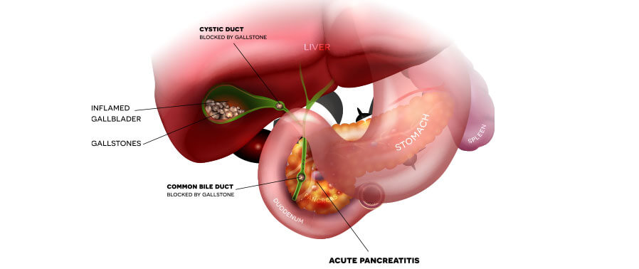 Gallstone Pancreatitis