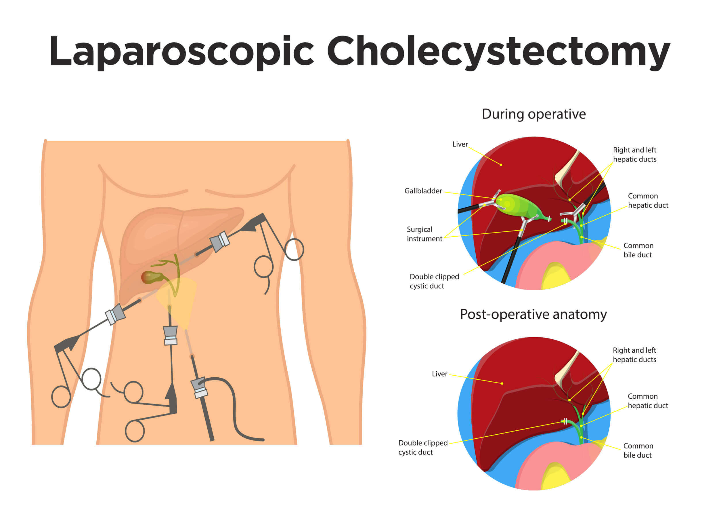 Gallbladder Removal Surgery