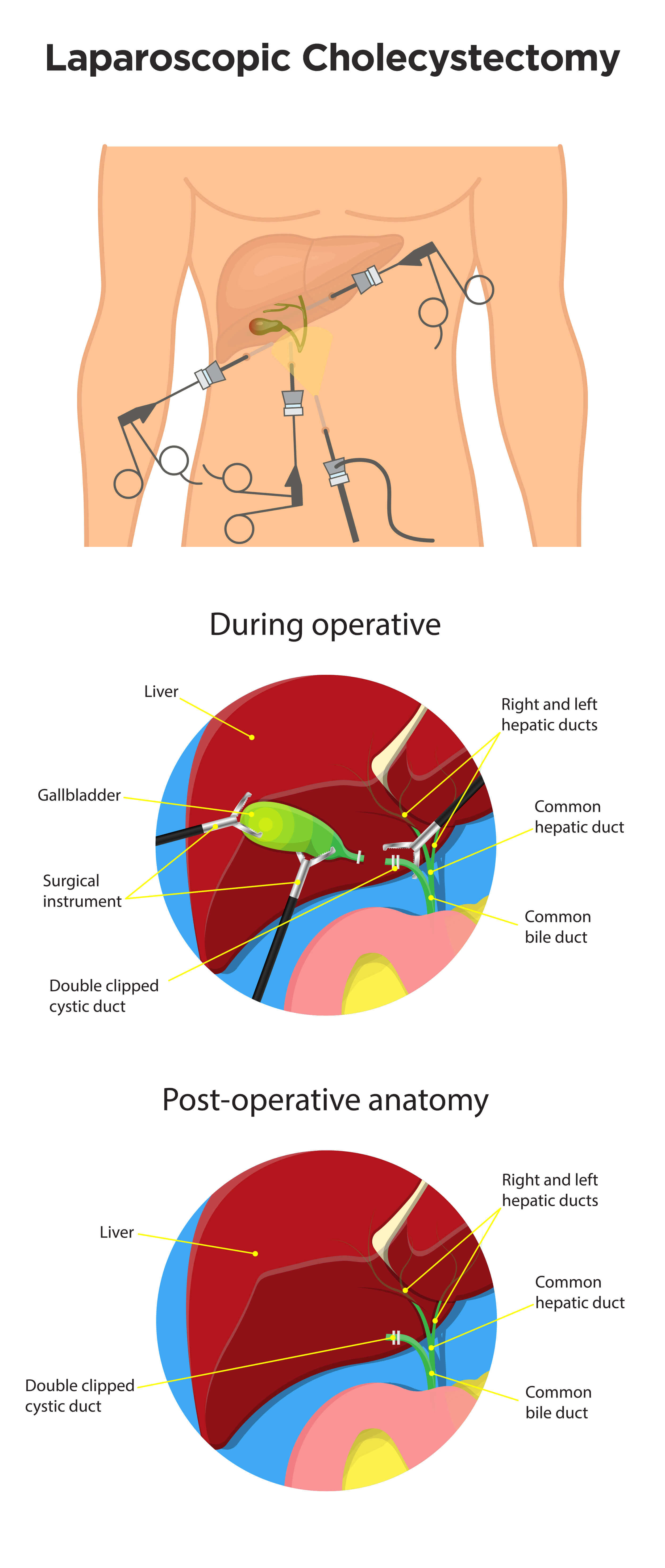 Laparoscopic Cholecystectomy Gallbladder Surgery